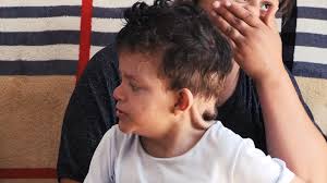 Rasti i "Benjamin Batton" ne Lezhe, femija 8 vjeç i familjes Korra vuan nga  sindromi i plakjes se parakoheshme