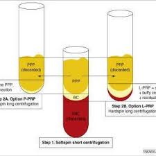 2018, article id 9867402, 6 pages immediate temporization was performed with composite crowns on immediately placed dental implants. Pdf Platelet Rich Fibrin Prf In Dentistry