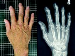 Dette er en pekerside, og inneholder kun pekere til forskjellige betydninger av dette ordet. Artrose Slitasjegikt Bindevevssykdommer Nobindevevssykdommer No