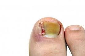 Image result for Toenail Removal