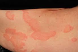 Image result for Hives