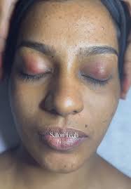 Hydrafacial for Radiant and Smooth Skin