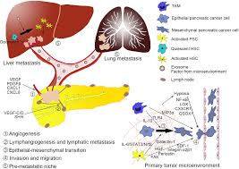 Pancreatic cancer is a deadly disease with high mortality due to difficulties in its early diagnosis and metastasis. Tumor Microenvironment Participates In Metastasis Of Pancreatic Cancer Molecular Cancer Full Text