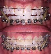 Our friendly customer care team is here to help you choose the right brace. 2 Month Progress Elastics Are 100 Worth The Pain Braces