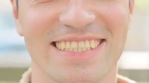 Image result for Tooth Discoloration