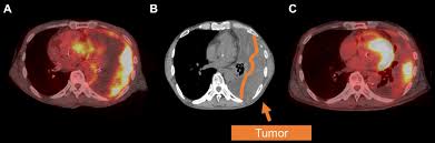 Location, and radiological findings (ct or magnetic resonance imaging . Effectiveness Of Nivolumab On Sarcomatoid Malignant Pleural Mesothelioma With Eosinophilia And Eosinophilic Pleural Effusion Journal Of Thoracic Oncology