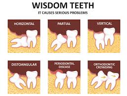 It is advisable to have it removed at the time as removing it years later makes the extraction process more complicated and expensive. Wisdom Teeth Why We Have Them And When To Remove Them Hamburg Dental Care