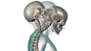 También pueden ocurrir fracturas, siendo la región. Indemnizacion Por Latigazo Cervical En Accidentes De Trafico Accigest