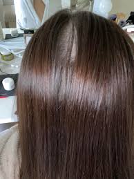 I've been on tons of different combinations of meds, am now on. New Bald Spot Making It Way Down Anyone Experience This Femalehairloss