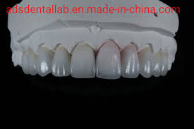 China Full Service Dental Product Of Ips E Max Crown From Ads Dental Lab China Emax Onlay Emax Inlay Onlay