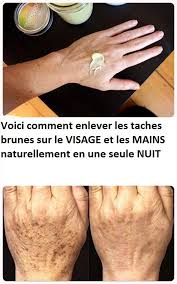 Voici Comment Enlever Les Taches Brunes Sur Le Visage Et Les Mains Naturellement En Une Seule Nuit Lotion Info Workout
