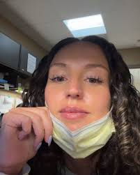 The evolution of lip filler from before, to bruising, to beautifully  healed... Everyone heals differently, but bruising and swelling are part of  the process—and yes, it's worth it! 🙌 Have questions about