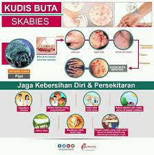 ◾sapu dari bahagian leher hingga ke tapak kaki. Klinik Avicenna Apa Itu Kudis Buta Kudis Buta Atau Facebook