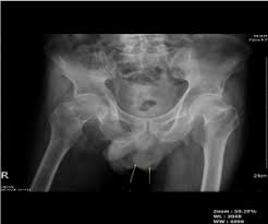It is a true urological emergency due to the high mortality rate but fortunately, the condition is rare. Early Signs Of Fournier Gangrene Radiological Characteristics