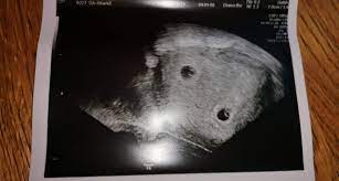 6ssw Zwei Fruchthole Woran Erkennt Man Ob Sie Eineiig Oder Zweieig Sind Und Kann Es Sein Das Sie An Verschieden Tagen Gezeugt Worden Sind Medizin Schwangerschaft Zwillinge