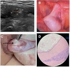 Image result for Undescended Testicle