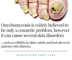 Image result for onychomycosis