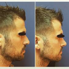 13 opiniones de Rinoplastia Integral (Cirujano plástico) en San Isidro  (Lima)