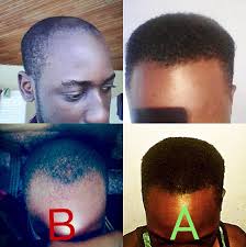 For men, the neckline is usually squared off, and the portions of the hair that are short are trimmed into a short, tapered, perimeter edge. Is It Normal For 18 Year Old Males To Have A Receding Hairline Is There Anything I Can Do To Stop It From Worsening Quora