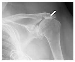 Image result for Shoulder Imaging