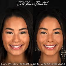 Here is another example of how changing only the teeth enhanced this  patient's entire face. This patient had several teeth issues that she felt  were distracting and grabbed too much negative attention.