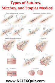 Surgical Stitches
