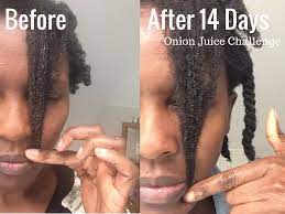 These cells nourish scalp and hair follicles and promote healthy hair growth. How To Use Onion Juice For Hair Growth Incl 9 Easy Diy Recipes