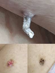 Image result for cornu cutaneum)