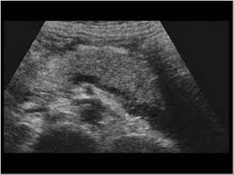 Maybe you would like to learn more about one of these? Abdomen And Retroperitoneum 1 3 Pancreas Case 1 3 5 Acute Pancreatitis Ultrasound Cases