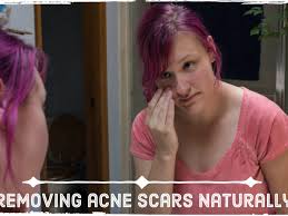 Home Remedies To Remove Deep Acne Scars Bellatory