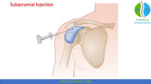 Image result for Subacromial Space Injection