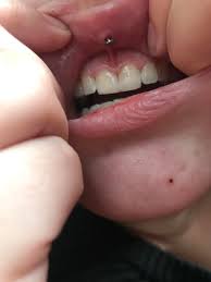 Jewelry that's too small can embed in the skin, and larger jewelry might scrape against your gums and contribute to a receding gum line. Embedding Or Nesting I Got My Medusa About Two Weeks Ago And It S Sore On The Inner Side Of My Lip I Know Nesting Is Normal But When I Touch It With