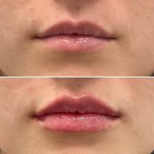 We did not find results for: Lip Fillers And Lip Augmentation Adam J Oppenheimer Md