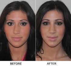 Removing nasal polyps without surgery is possible if you know the step by step natural methods described here. Sinus Surgery Photos Before And After New York Ny Sinus Surgeon