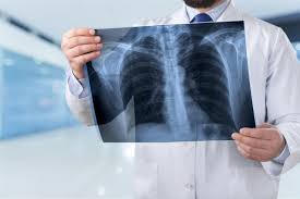 A pancoast tumor is a type of lung cancer that occurs in the upper portion of the lungs, and can affect the nervous system. How Do Doctors Check For Mesothelioma Lung Cancer Lung Cancer Pintas Mullins Law Firm