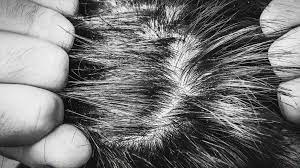 Too much oil in the skin can cause a buildup of skin cells, which then flake off. Dry Scalp Causes And Treatment Options