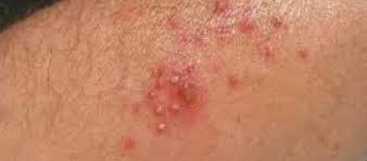 Image result for Skin Infection