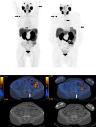Find the information you need today. Theranostics For Advanced Prostate Cancer Current Indications And Future Developments European Urology Oncology
