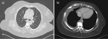 Pleural effusion is an accumulation of fluid in the pleural cavity between the lining of the lungs and suspected transudative bilateral effusions with atypical features (e.g., fever, pleuritic chest pain. An Uncommon Cause Of Pleural Effusion European Respiratory Society