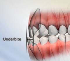 When Is The Proper Time To Treat Underbite Teeth Straightening Dental Problems General Dentistry
