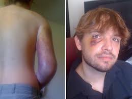 Dorian Barton testifies shoulder broken at G20 arrest trial