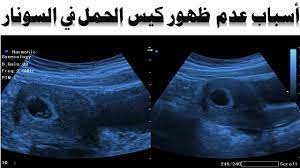 الاسبوع الخامس من الحمل عالم حواء. Ø¹Ø§Ù„Ù… Ø­ÙˆØ§Ø¡ Ø§Ù„Ø­Ù…Ù„ Ø¨Ø¹Ø¯ Ø§Ù„Ø§Ø¬Ù‡Ø§Ø¶