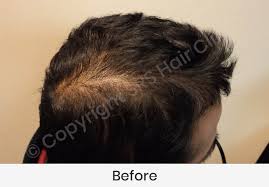 Gold standard european safety testing. Srs Hair Clinic Tauranga Srs Hair Clinic New Zealand Auckland Hamilton Tauranga