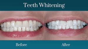Image result for Tooth Discoloration