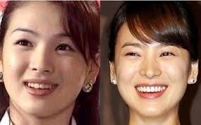 Netizen Buzz Pann Stars Who Fixed Their Teeth