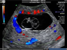 Diagnostic Ultrasound In The First Trimester Of Pregnancy