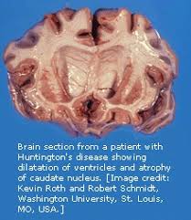 We are working to resolve the issue as quickly as possible and apologize for the inconvenience. Huntington Disease Genes And Disease Ncbi Bookshelf