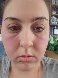 Do others with sarcoidosis experience eye symptoms?