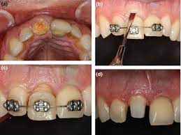 There are some patients that feel ok to drive themselves after the root canal procedure. A New Classification System For The Restoration Of Root Filled Teeth Zarow 2018 International Endodontic Journal Wiley Online Library