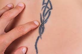 For example, a wooden block covered by a bandage. How Much Does Laser Tattoo Removal Cost Still Waters Day Med Spa